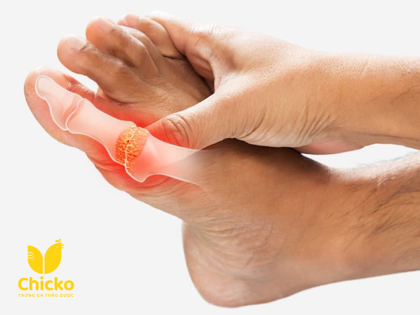 Bệnh Gút Có Ăn Được Trứng Gà Không? Giải Đáp Giúp Bạn An Tâm 2 Bệnh gút