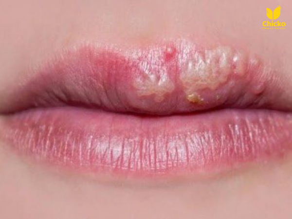 môi bị tổn thương sau xăm