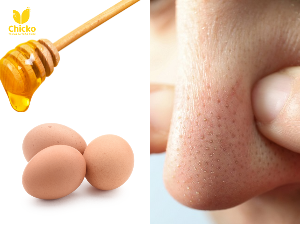 Cách trị mụn đầu đen ở mũi bằng trứng gà hiệu quả bất ngờ 9 cách trị mụn đầu đen ở mũi bằng trứng gà