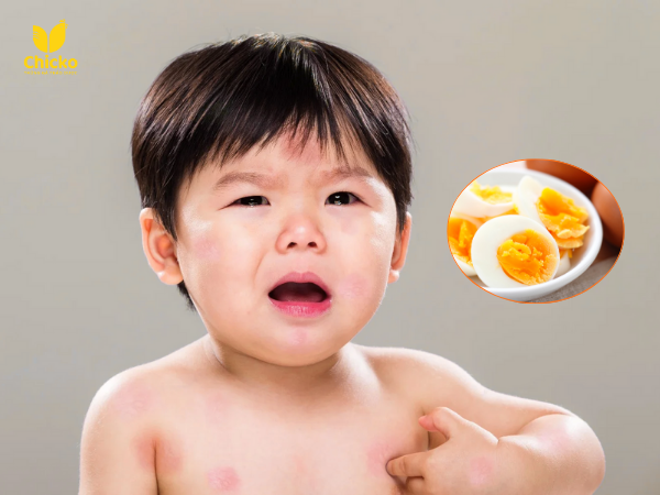 Trẻ Bị Dị Ứng Trứng Gà Phải Làm Sao? Cách Xử Lí An Toàn 13 trẻ bị dị ứng trứng gà phải làm sao