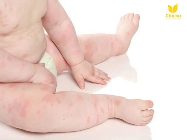 Các biểu hiện khi trẻ bị dị ứng