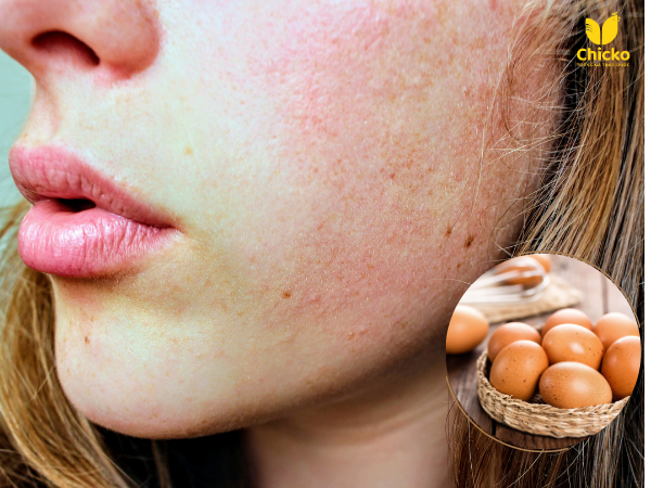 Chữa Dị Ứng Da Mặt Bằng Trứng Gà & Bí Quyết Phục Hồi Da 7 chữa dị ứng da mặt bằng trứng gà