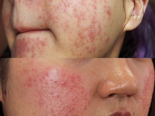 Chữa Dị Ứng Da Mặt Bằng Trứng Gà & Bí Quyết Phục Hồi Da 2 dị ứng da mặt trầm trọng