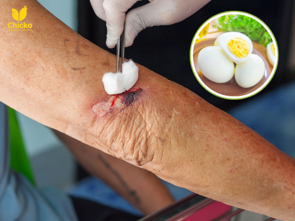 nên ăn trứng gà khi có vết thương hở