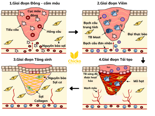 Sẹo lồi hình thành như nào?